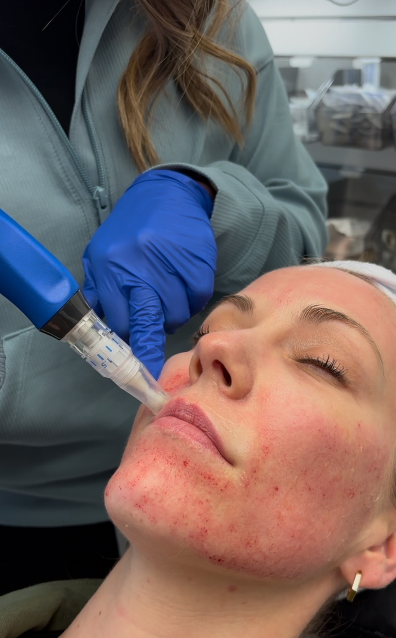 microneedling — treatment for acne